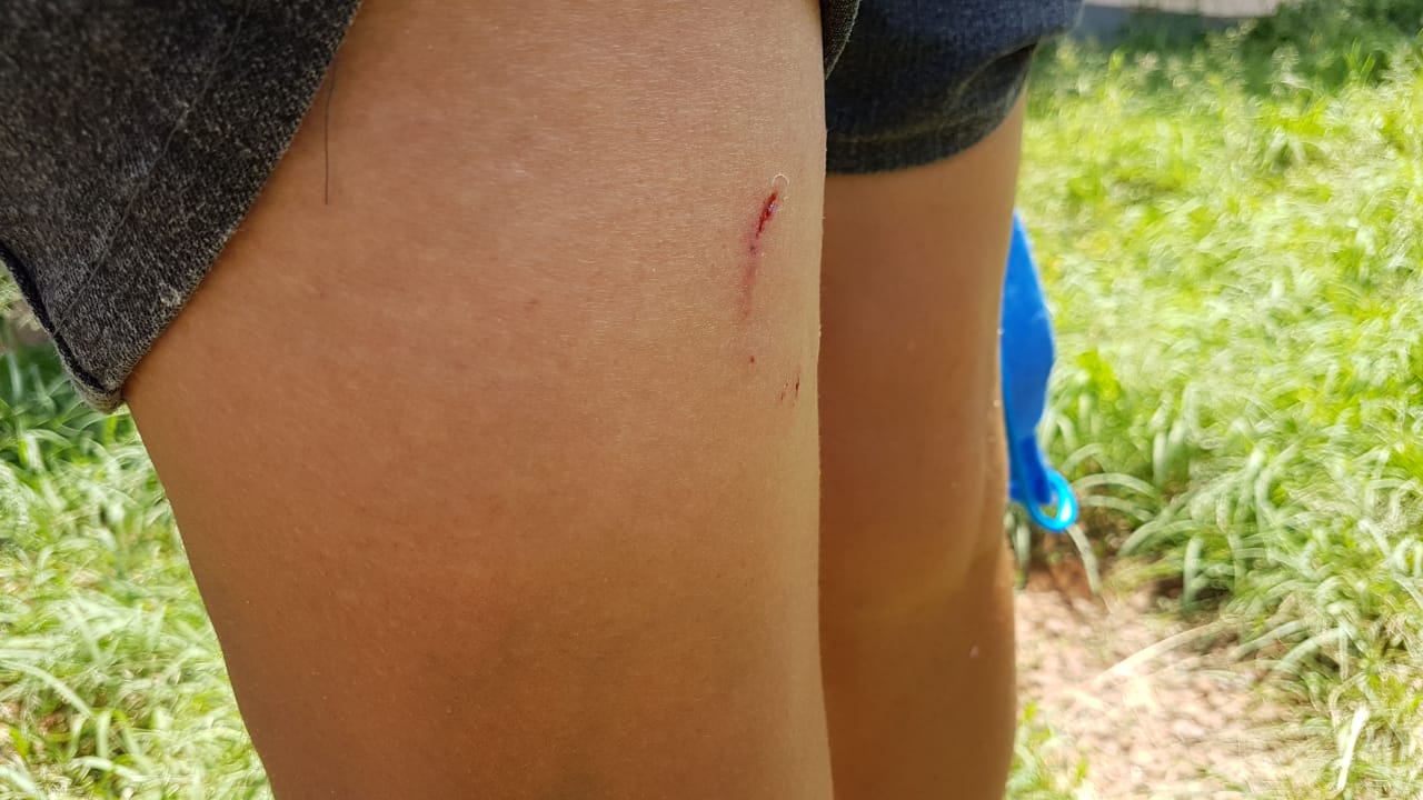 Imagem referente a Adolescente de 14 anos é atacada por cachorro no Coqueiral