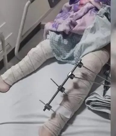 Imagem referente a Equipe médica é afastada após operar perna errada de criança de seis anos