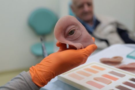 Imagem referente a HR produz pelo SUS próteses faciais que recuperam autoestima dos pacientes