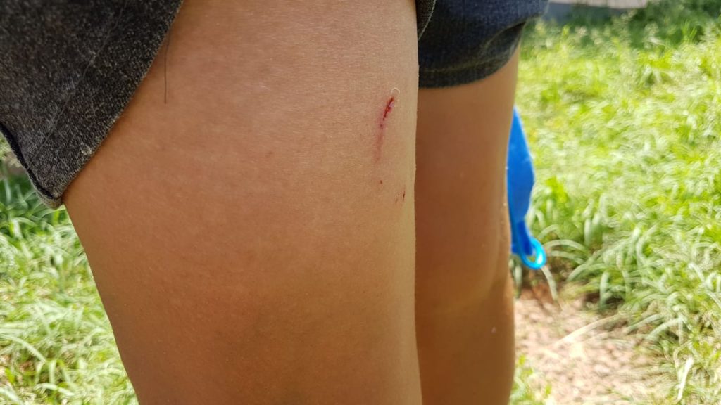 Adolescente de 14 anos é atacada por cachorro no Coqueiral