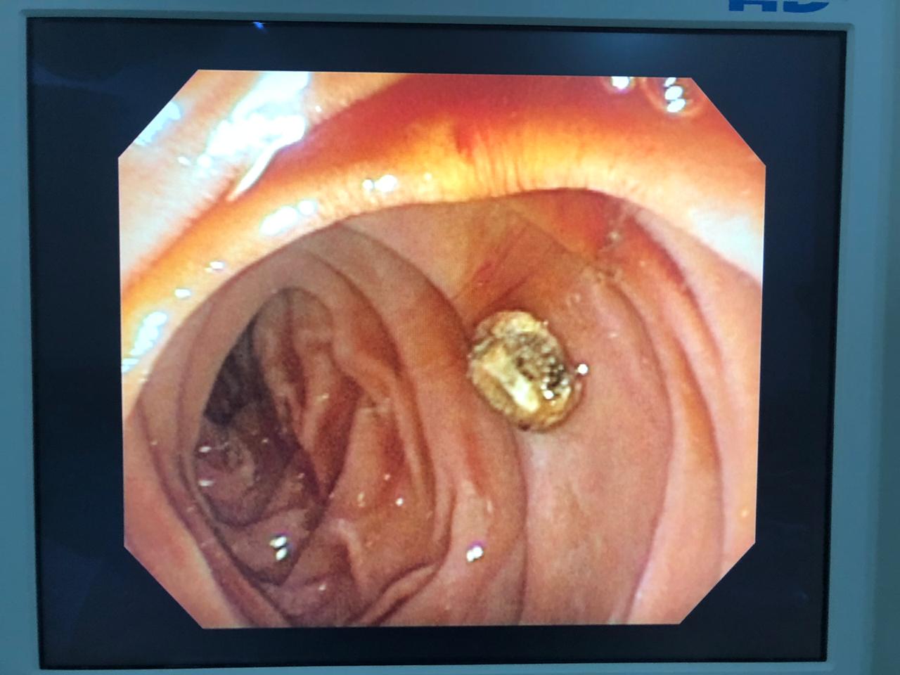 Quem fez cirurgia de vesícula pode se abaixar? Confira aqui!