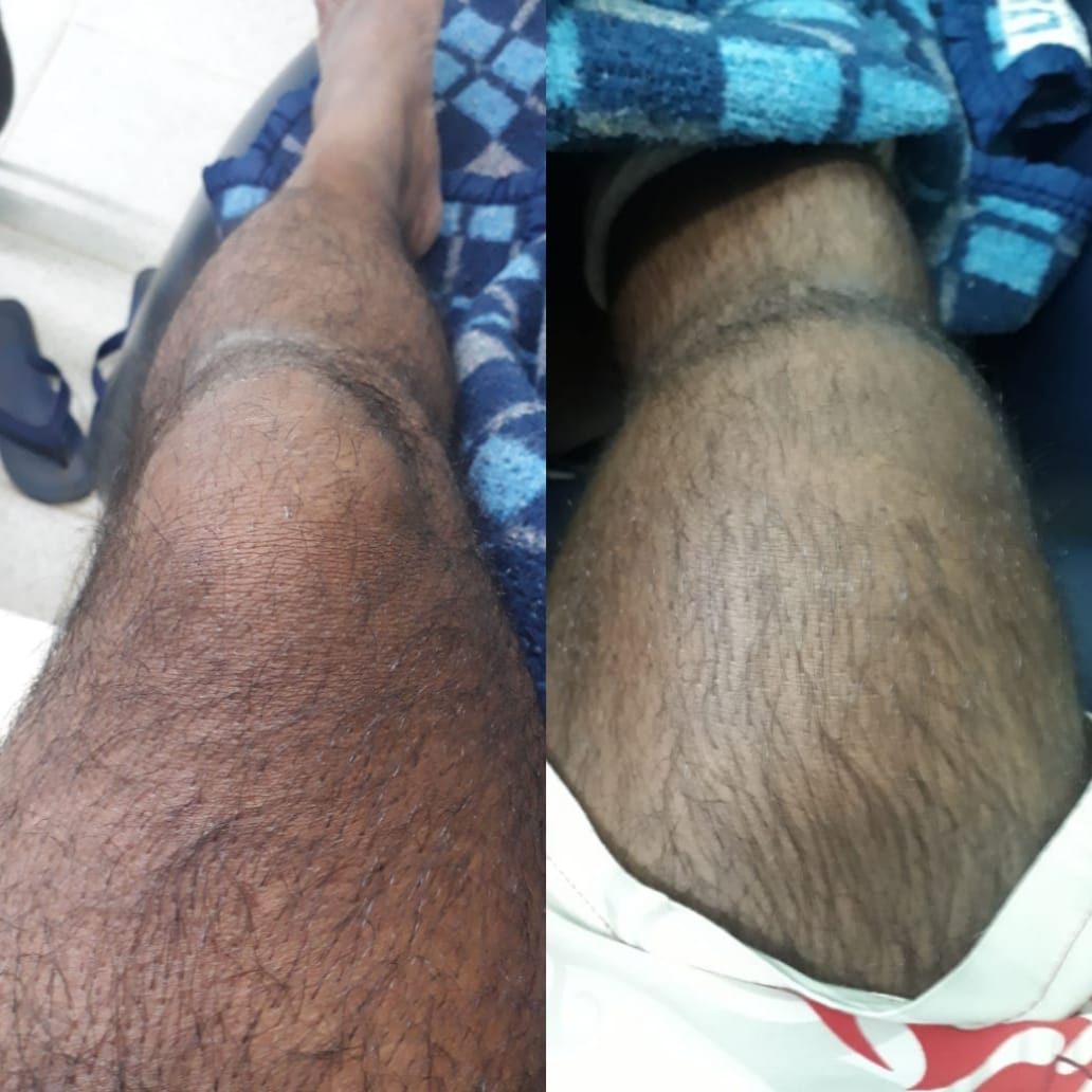 Após acidente de trabalho, homem aguarda leito hospitalar desde sexta-feira Imagem referente a Após acidente de trabalho, homem aguarda leito hospitalar desde sexta-feira
