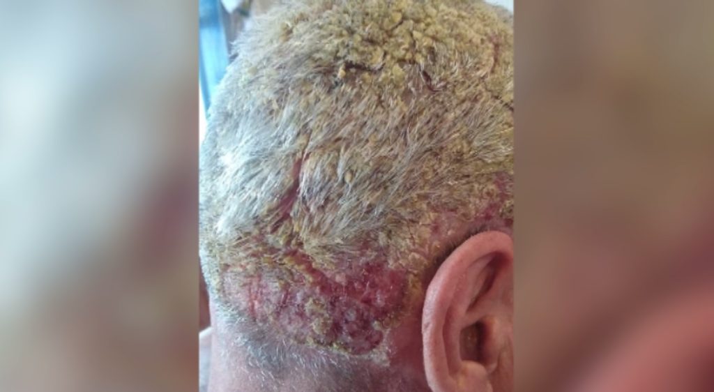 Filho pede ajuda para o pai, Claudino Nobre, de 54 anos, diagnosticado com doença rara