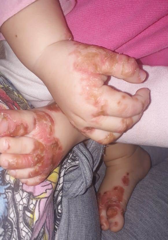 Família busca diagnóstico a criança que sofre com bolhas pelo corpo Imagem referente a Família busca diagnóstico a criança que sofre com bolhas pelo corpo