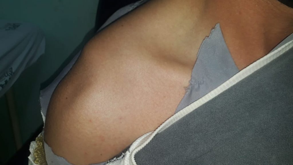 Ao ser atacado por cachorro, homem sofre queda e agora aguarda por cirurgia no ombro