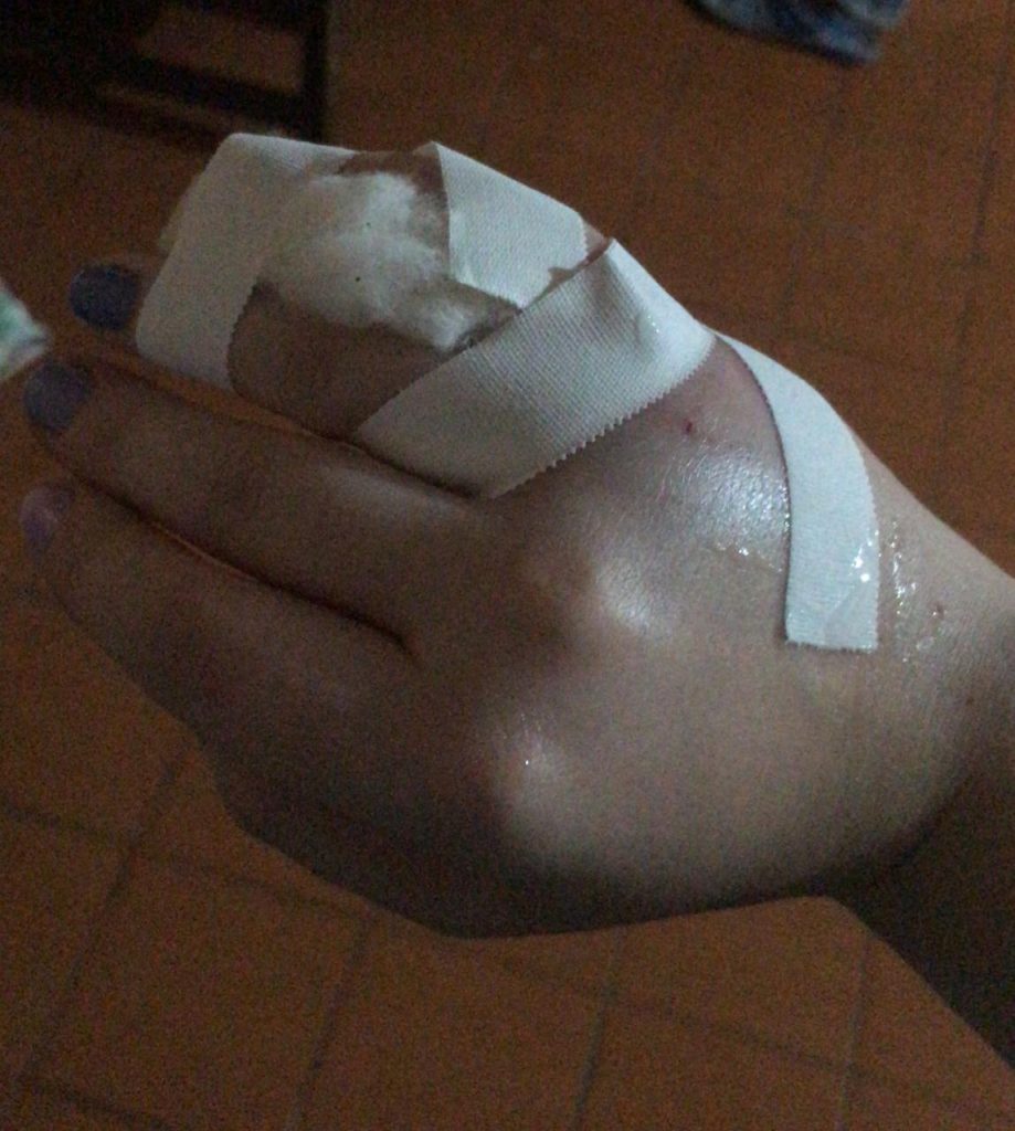 Ciclista faz arrecadação para pagar cirurgia após acidente na Rua Fortaleza