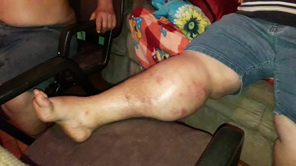 Homem que pediu a ajuda da população para fazer cirurgia na perna comunica que procedimento foi realizado com sucesso