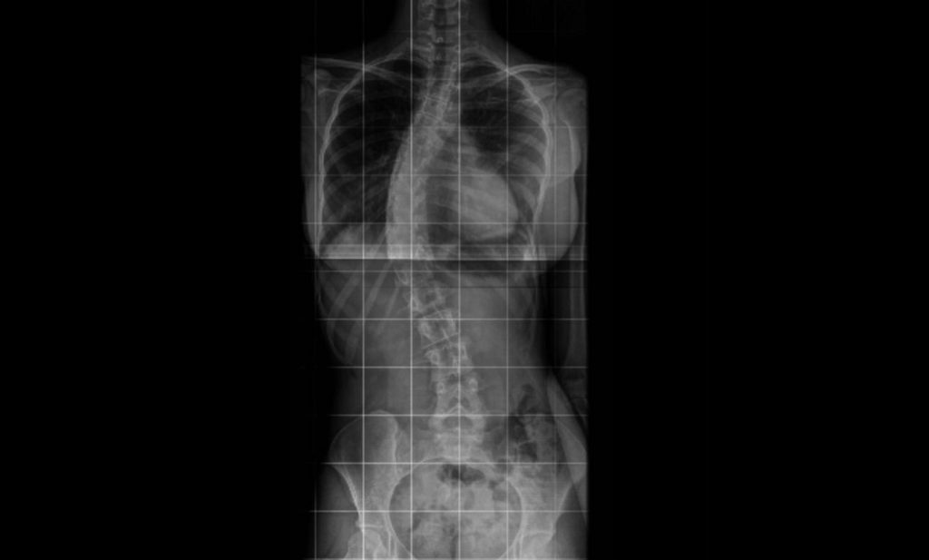 Adolescente com grave problema de escoliose precisa de ajuda para custear cirurgia