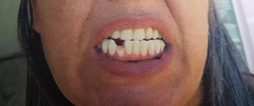 “Arrancaram 18 dentes de uma vez, eu quase morri”, diz paciente sobre Clínica Odontológica de Cascavel