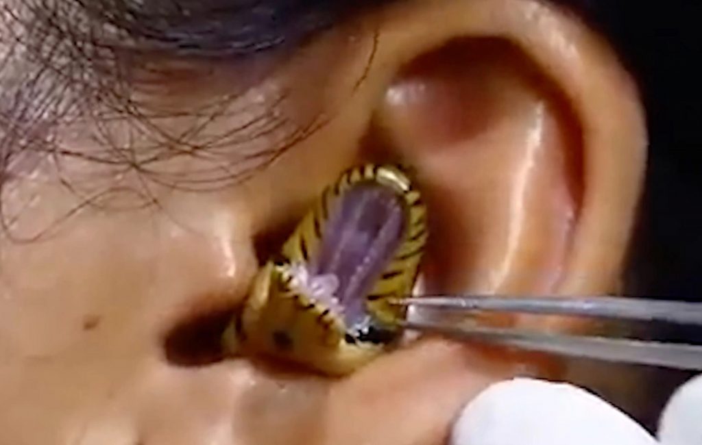 Vídeo de cirurgião retirando cobra viva de dentro de ouvido de mulher viraliza