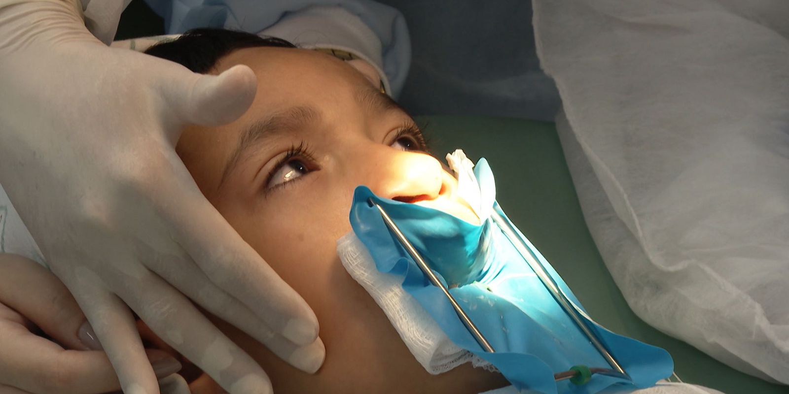 Genética e inflamação na gravidez explicam lábio leporino Imagem referente a Genética e inflamação na gravidez explicam lábio leporino