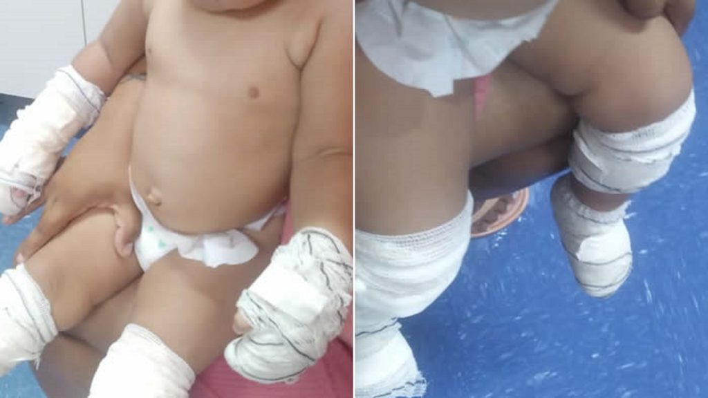 Bebê sai do primeiro dia da creche com queimaduras causadas pelo sol