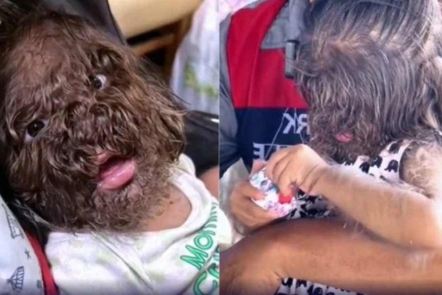 Criança com rara síndrome do lobisomem é adotada por casal