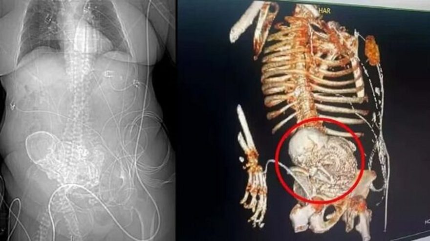 Milagre ou maldição? Feto calcificado é encontrado em idosa após 50 anos