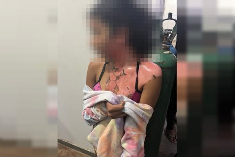 Imagem referente a CENAS FORTES: adolescente é queimada com água fervente e agredida pela própria tia 