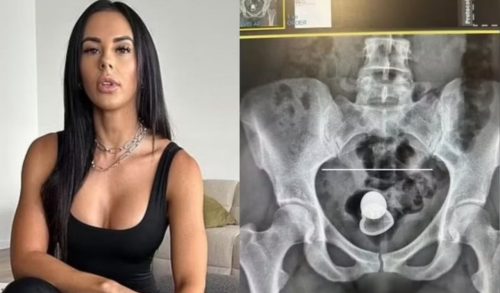 Imagem referente a Atriz +18 fica com plug anal preso no corpo e precisa ser sedada