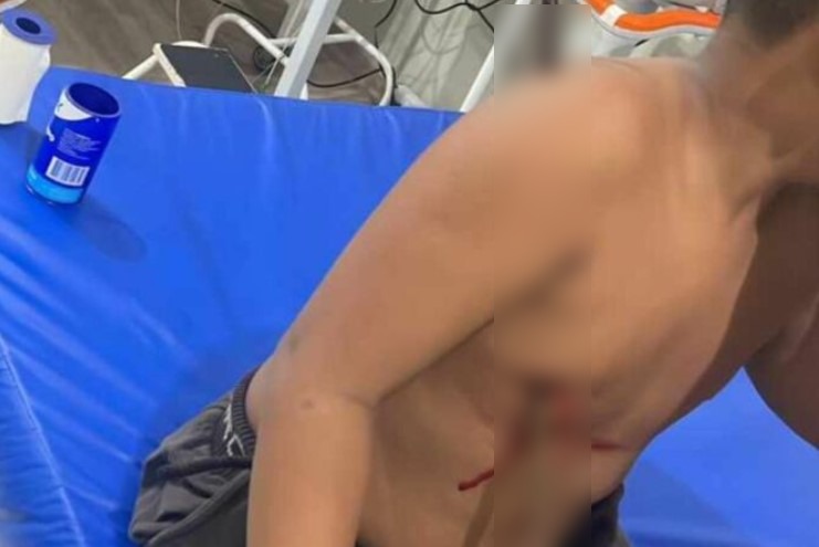 Menino que brincava em área de construção cai e tem peito atravessado por barra de ferro