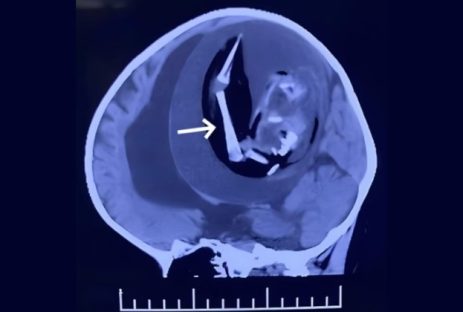Médicos encontram feto com braços dentro do crânio de bebê de 1 ano Imagem referente a Médicos encontram feto com braços dentro do crânio de bebê de 1 ano