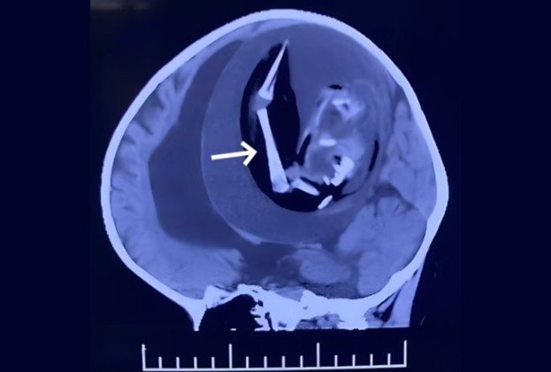 Médicos encontram feto com braços dentro do crânio de bebê de 1 ano