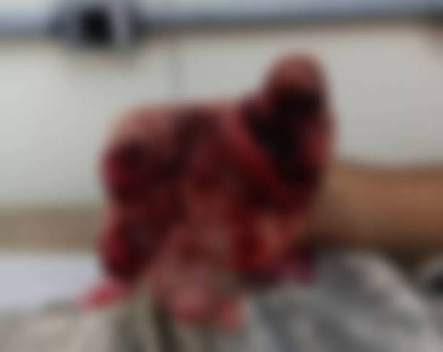 Adolescente tem mão dilacerada após explosão de bomba de São João