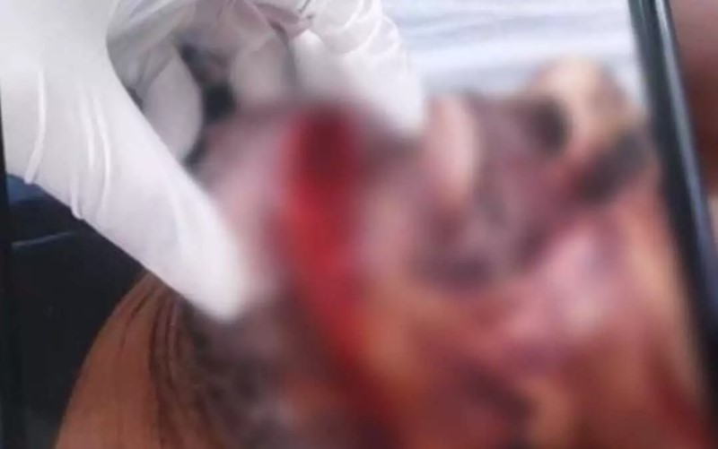 Morre homem que teve mão amputada e cabeça “rachada” com faca pela esposa