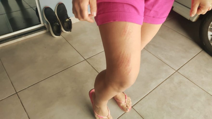 Após ser atacada por Pitbull, vítima relata momentos de terror