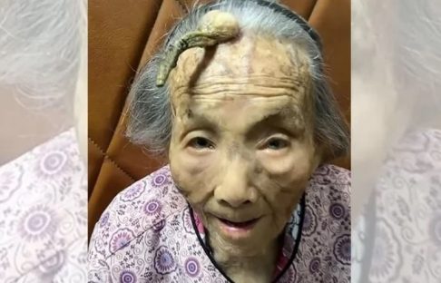 Imagem referente a Mulher de 107 anos viraliza na web por “chifre” de 10 cm na testa