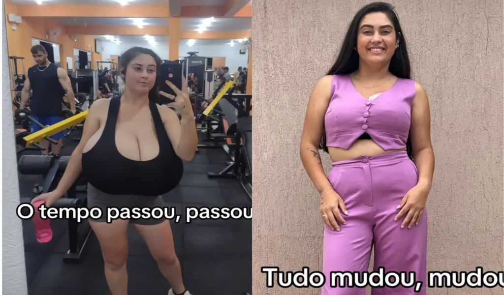 Estudante do Paraná retira 10 kg de seios; tinha os maiores do Brasil