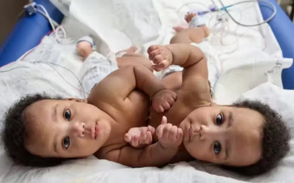 Médicos separam gêmeos siameses após 8 horas de cirurgia