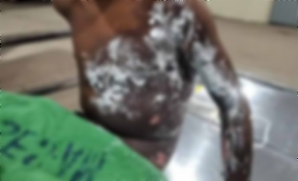 Criança indígena sofre queimaduras graves por choque elétrico