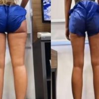 Imagem referente a Yasmin Brunet perde 14 kg de gordura após tratamento de lipedema