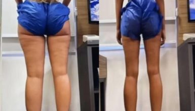 Imagem referente a Yasmin Brunet perde 14 kg de gordura após tratamento de lipedema