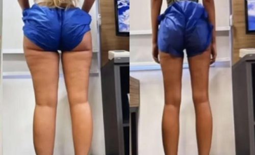 Imagem referente a Yasmin Brunet perde 14 kg de gordura após tratamento de lipedema