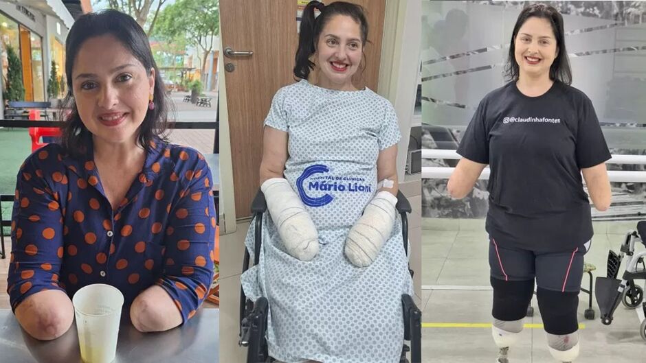 Professora vai ao médico com infecção urinária e tem pés e mãos amputadas após sofrer sepse Professora vai ao médico com infecção urinária e tem pés e mãos amputadas após sofrer sepse