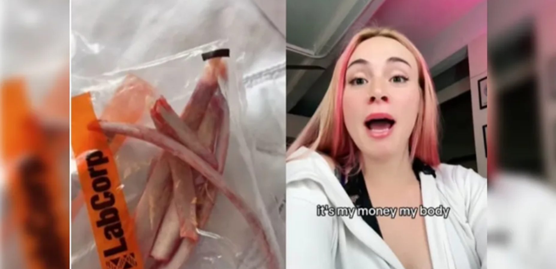 Mulher tira seis costelas e planeja transformá-las em coroa: 'Meu dinheiro, meu corpo!'