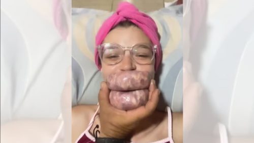 Imagem referente a Pai lança técnica barata e criativa de preenchimento labial para filha