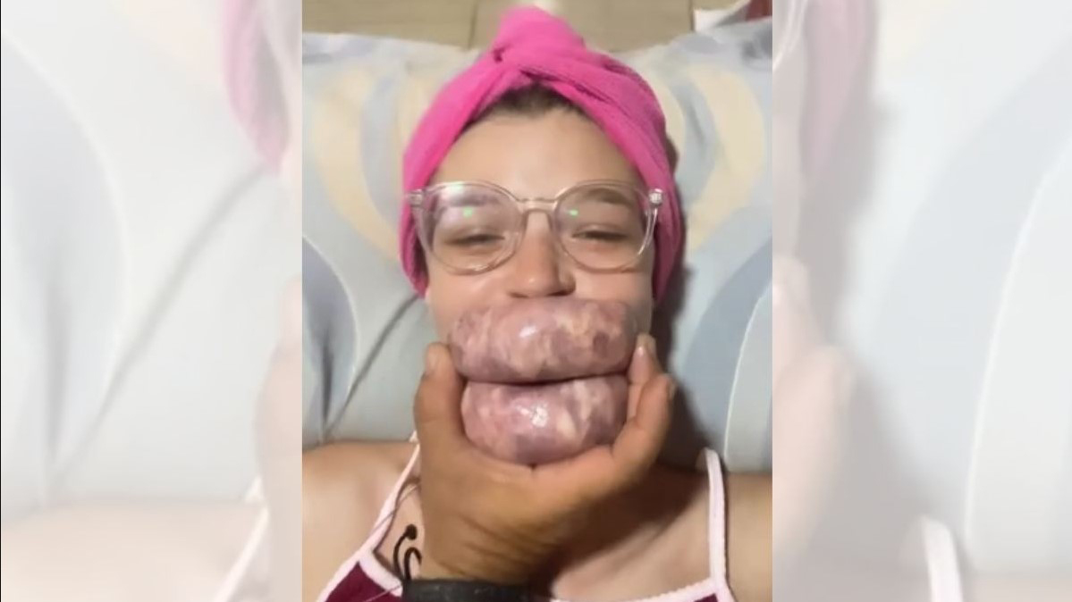 Pai lança técnica barata e criativa de preenchimento labial para filha