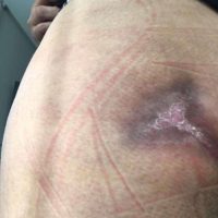 Imagem referente a Bumbum necrosado: Mais uma denúncia atinge clínica de Cascavel