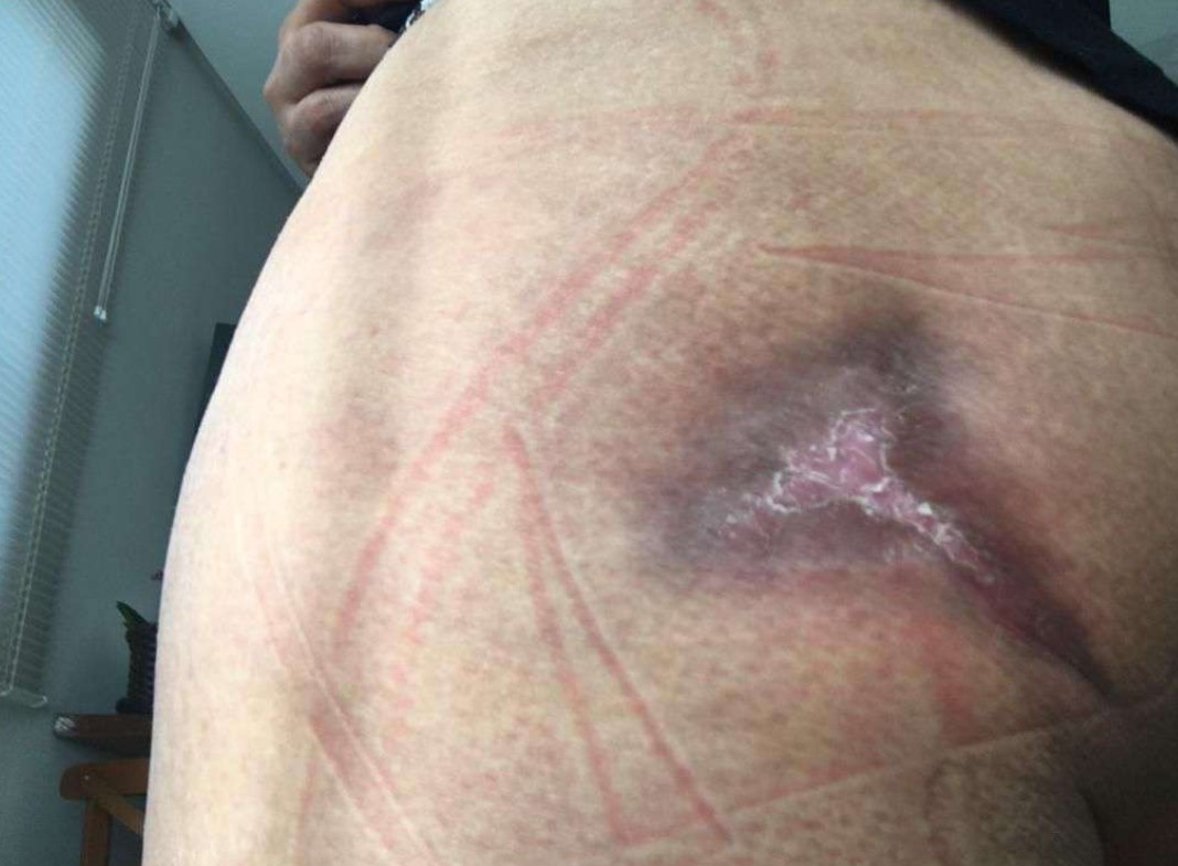 Bumbum necrosado: Mais uma denúncia atinge clínica de Cascavel