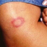 Imagem referente a Hanseníase: conheça verdades e mitos sobre a doença