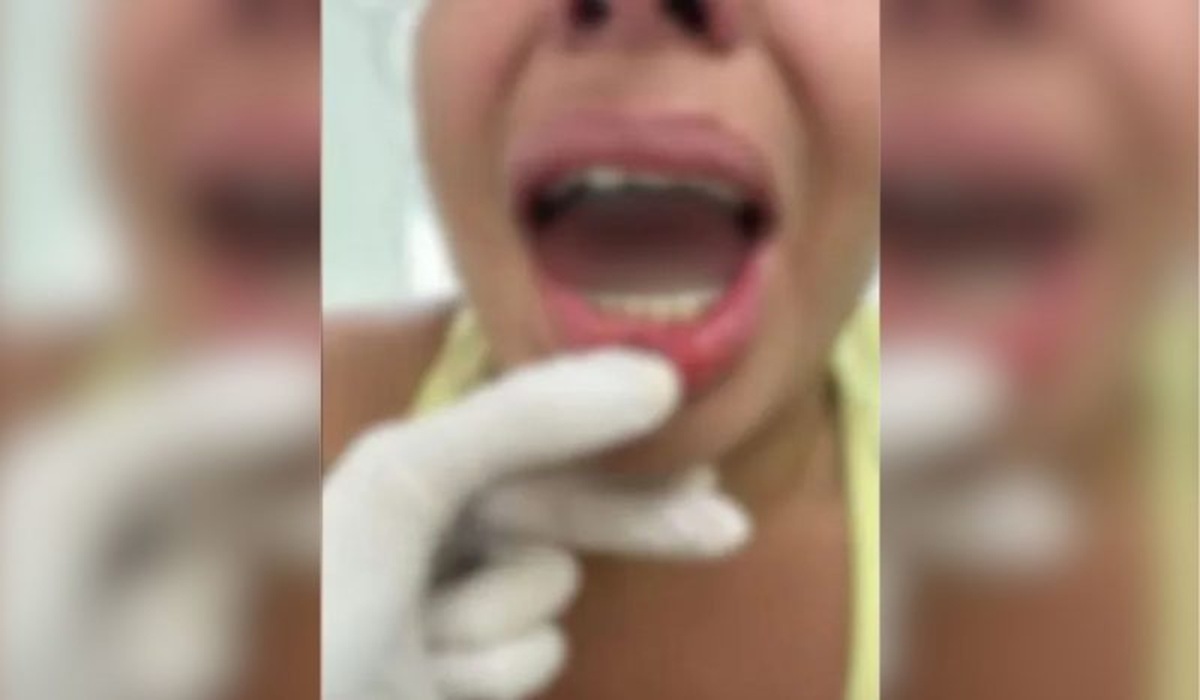 Agressor ignora medida protetiva, morde e arranca parte da língua da ex-companheira