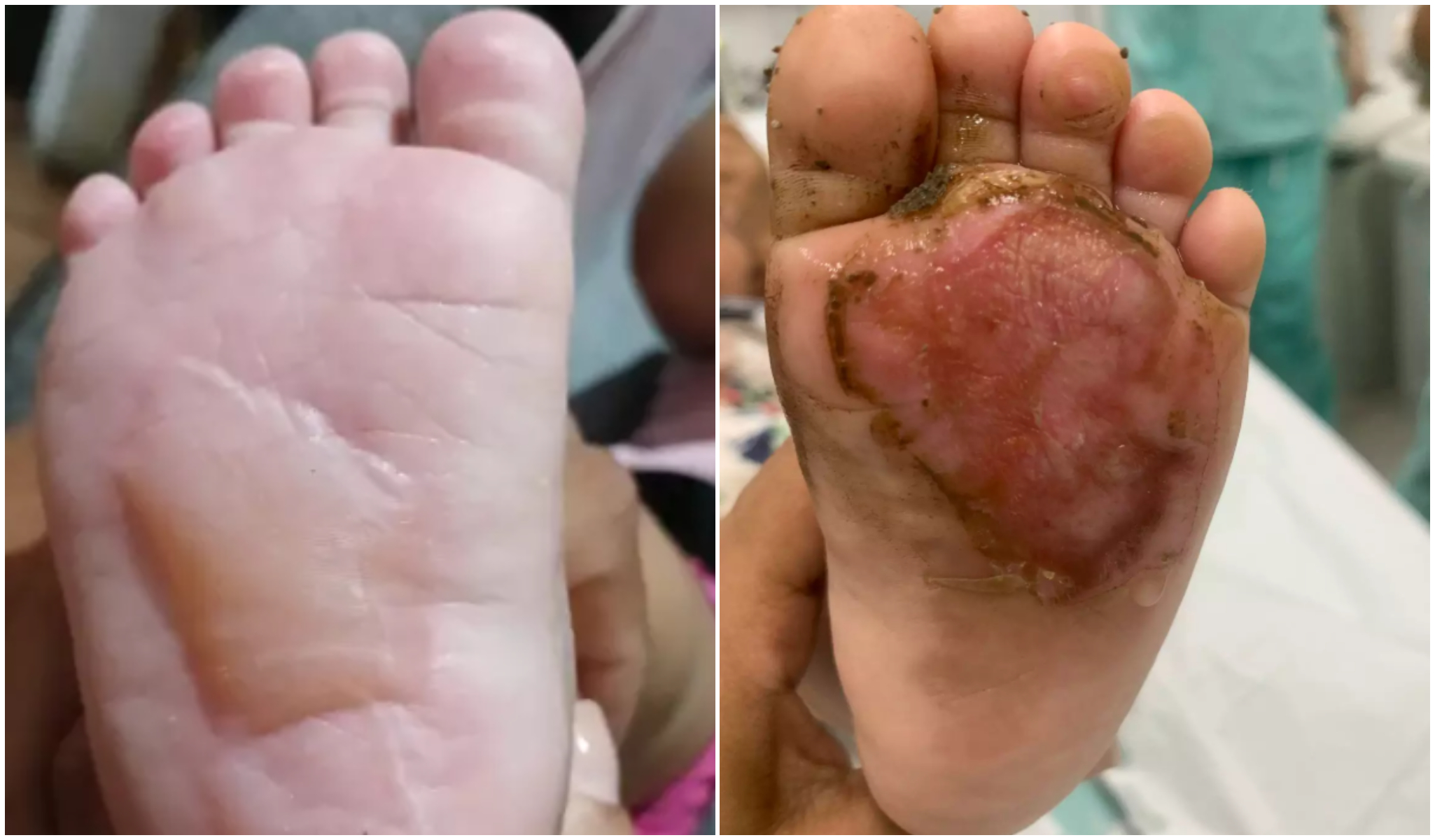 Criança sofre queimaduras de terceiro grau nos pés em creche