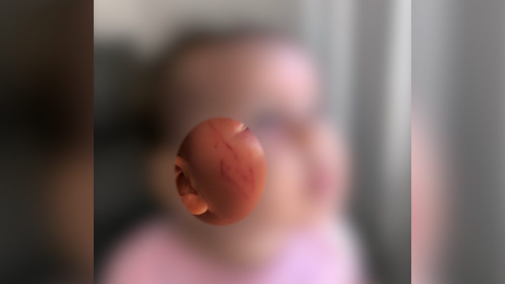 Mulher questiona CMEI de Cascavel após filha de 8 meses ficar com rosto machucado