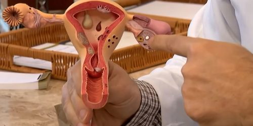 Imagem referente a Endometriose: conheça os sintomas e saiba como tratar a doença