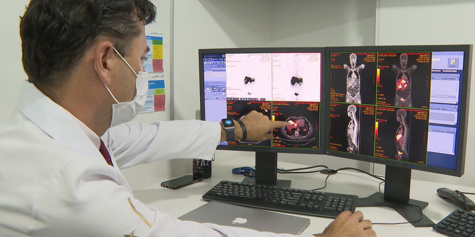 Rastreamento de câncer de intestino identifica lesões em 231 pacientes Rastreamento de câncer de intestino identifica lesões em 231 pacientes