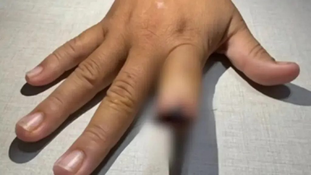 Homem arranca dedo de namorada com mordida durante briga