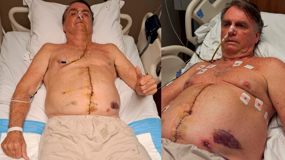 Bolsonaro mostra cicatriz e hematomas após cirurgia