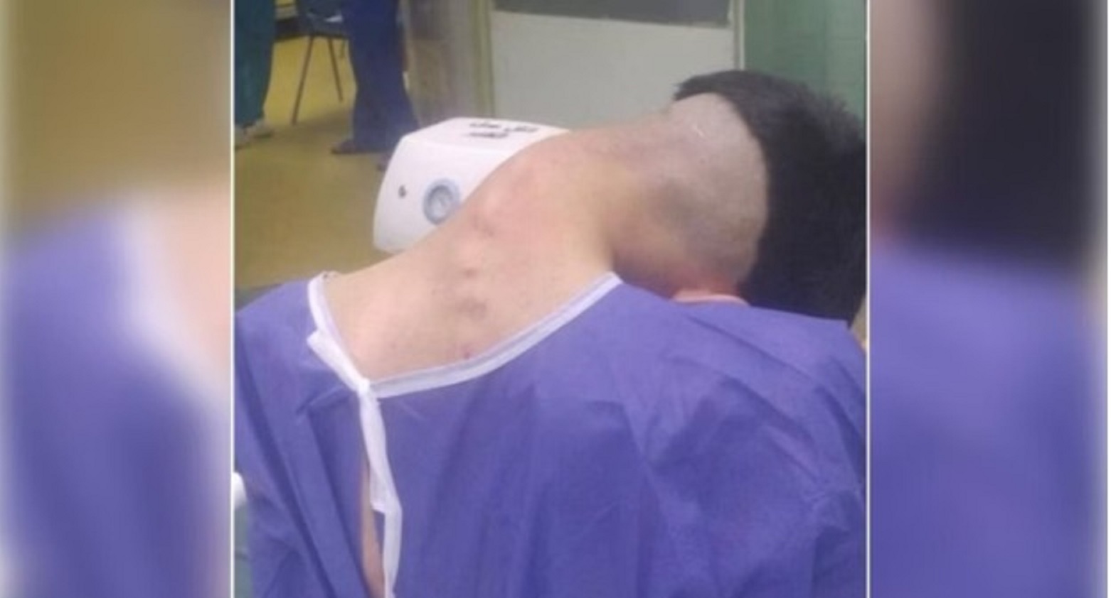 Abuso de drogas leva a diagnóstico raro de 'síndrome da cabeça caída' 