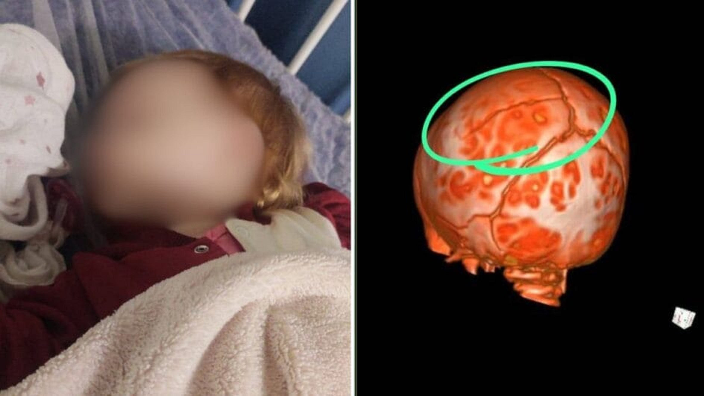 Queda em creche deixa bebê de cinco meses com fratura de 10 cm na cabeça Queda em creche deixa bebê de cinco meses com fratura de 10 cm na cabeça