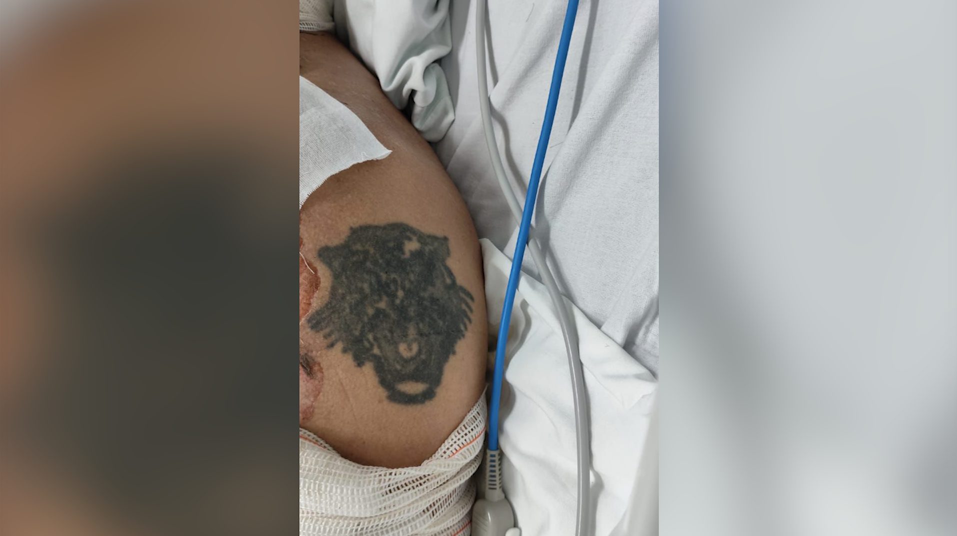 HUOP pede ajuda para identificar paciente com queimaduras graves